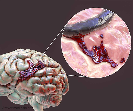 Xuất huyết não là một dạng của tai biến mạch máu não.png